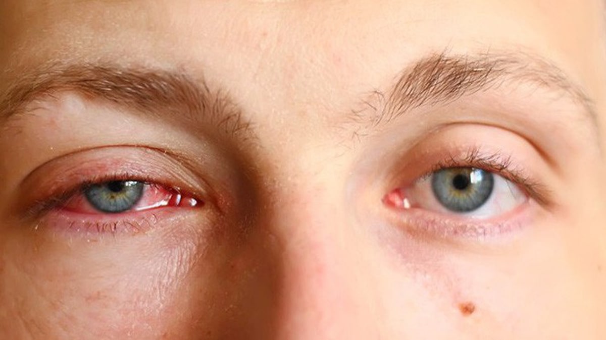Tìm hiểu chi tiết về căn bệnh đau mắt đỏ (Viêm kết mạc)